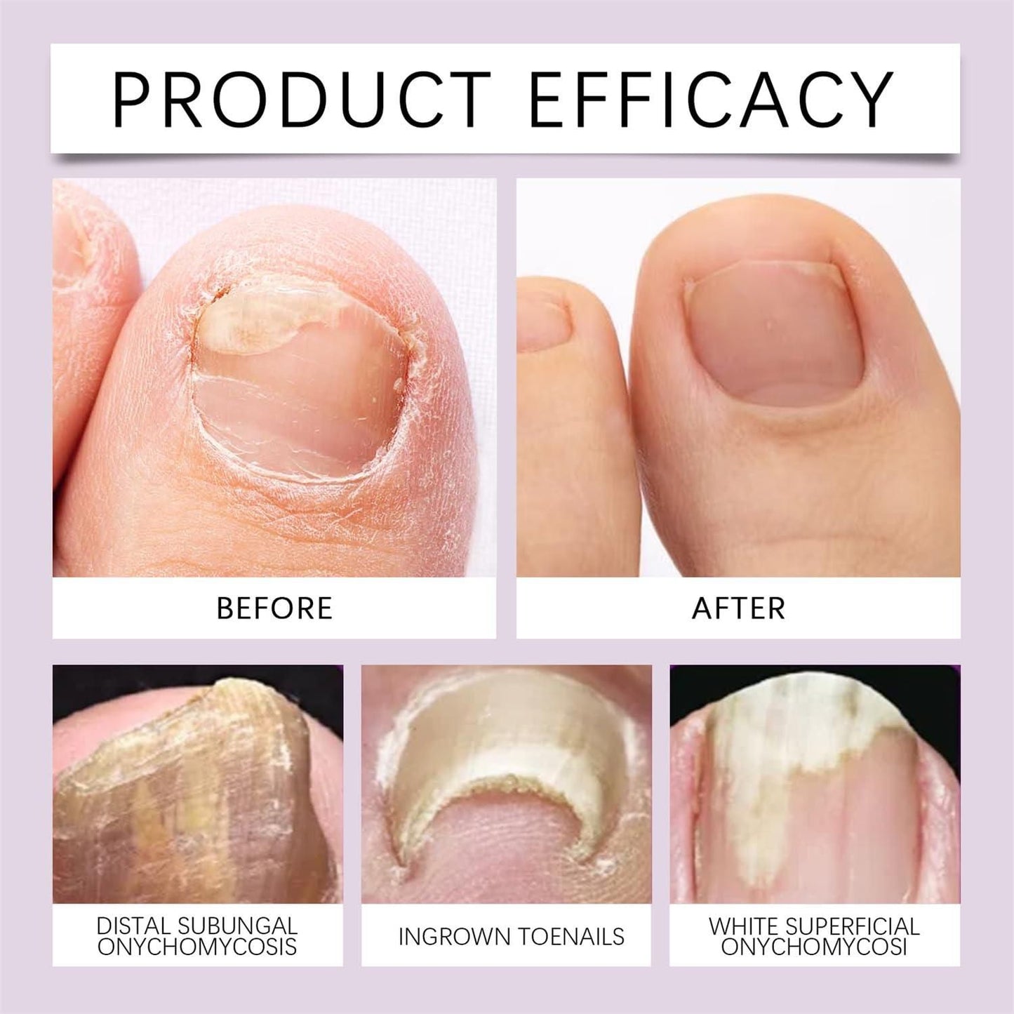 FungiFree™️ Bee Venom Nail Treatment Solution Serum