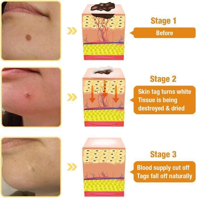 Bee Venom Wart Remover Spray (Buy 1 Get 1 Free😍)